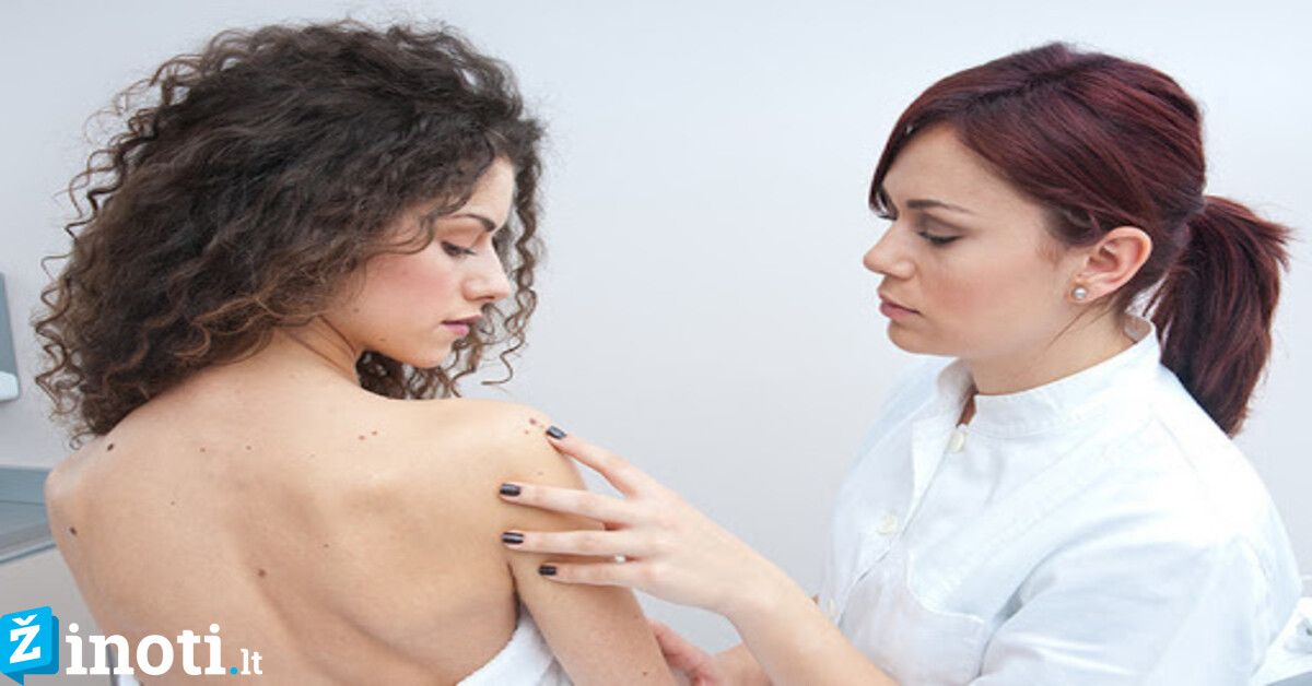 Kankina išsikėlę apgamai? Sužinokite, ar jie pavojingi sveikatai