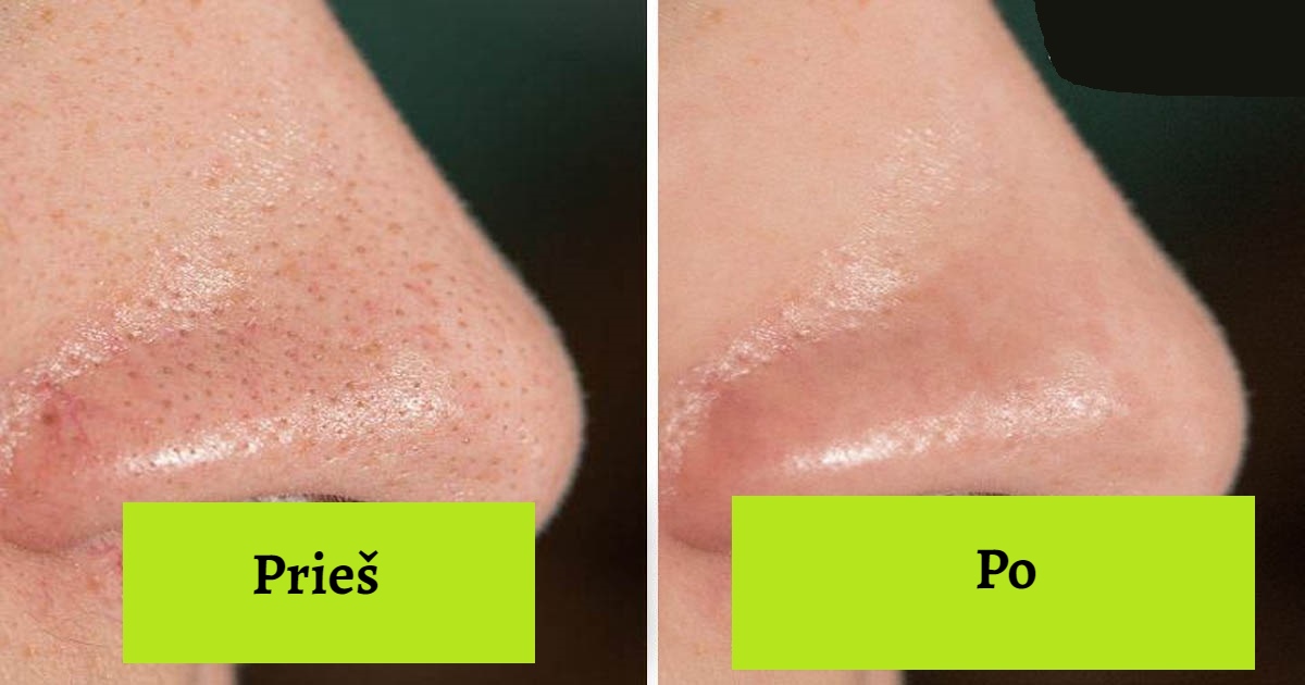 Dermatologai rekomenduoja: 10 patarimų, kaip sutraukti odos poras