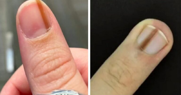 Linija ant nago: ką ji reiškia ir kada reikia sunerimti?