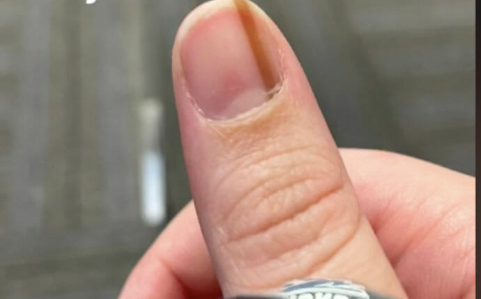 Linija ant nago: ką ji reiškia ir kada reikia sunerimti?