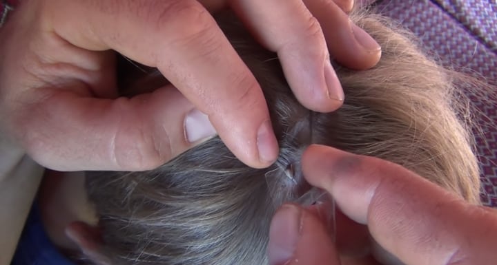Jums nereikės net pinceto: sužinokite, kaip ištraukti erkę naudojant plastikinį butelį!