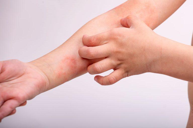 Egzema – kas tai, kaip ją atpažinti ir palengvinti kasdienybę?