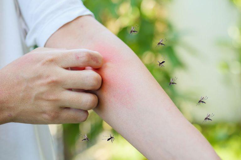 Kaip saugiai ir veiksmingai numalšinti niežėjimą po vabzdžių įkandimų