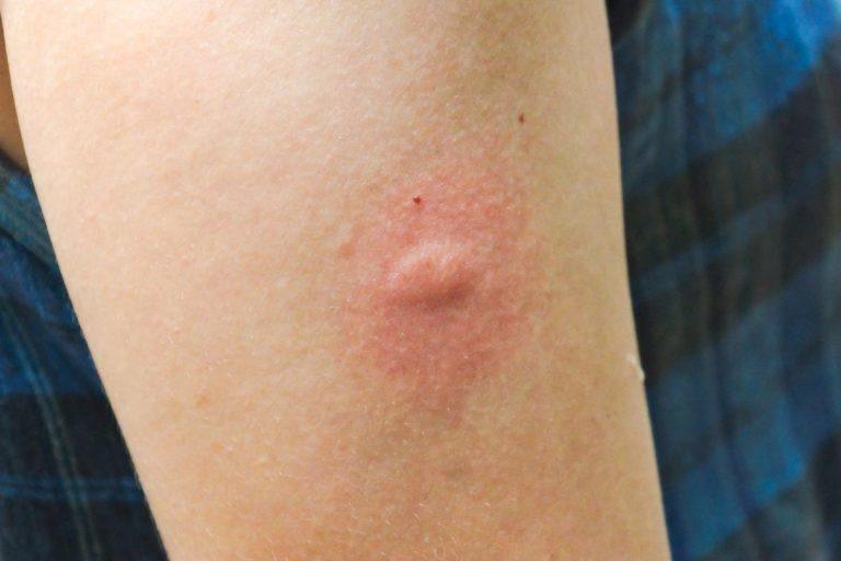 Vabzdžių įkandimai vasarą: kaip atpažinti ir tinkamai reaguoti