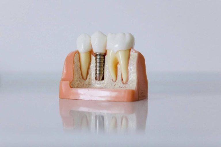 „Visi dantys ant 4 implantų“: nauja šypsena per vieną dieną – ar tai įmanoma?