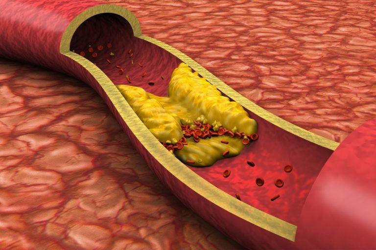 Aukštas cholesterolio kiekis: kaip mityba gali padėti sumažinti riziką