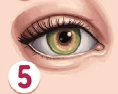 akys