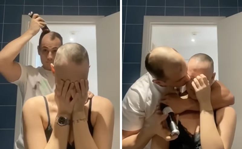 alopecijos
