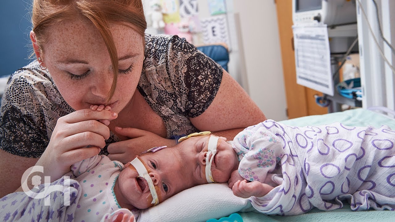Šioms Siamo dvynėms atskirti prireikė sudėtingos operacijos. Kaip jie atrodo dabar?