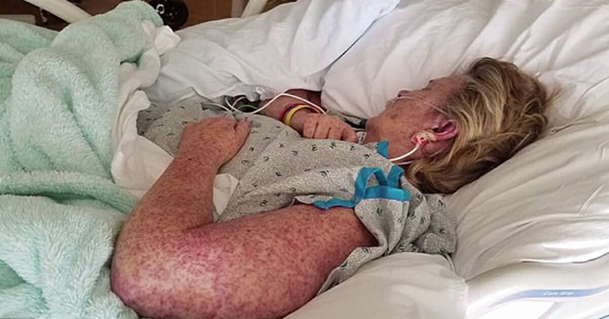 Moterį išbėrė ir ji mirė po 3 savaičių. Dabar jos dukra perspėja dėl klaidingos diagnozės!