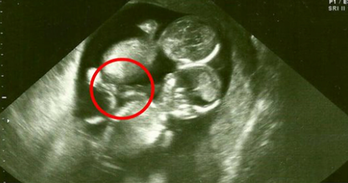 Po ultragarso gydytoja patarė nutraukti nėštumą, bet mama priėmė drastišką sprendimą