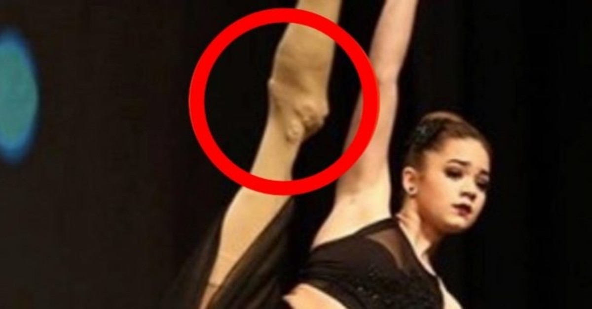 Mergaitė galvojo, kad jai ant kojos tik mėlynė. Tada ją ištiko tragedija!