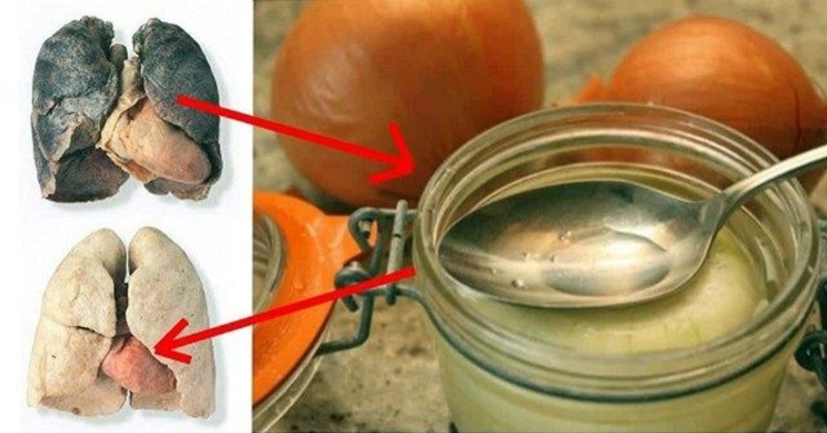 Sirupas, kuris padeda išvalyti plaučius ir atkurti sveikatą