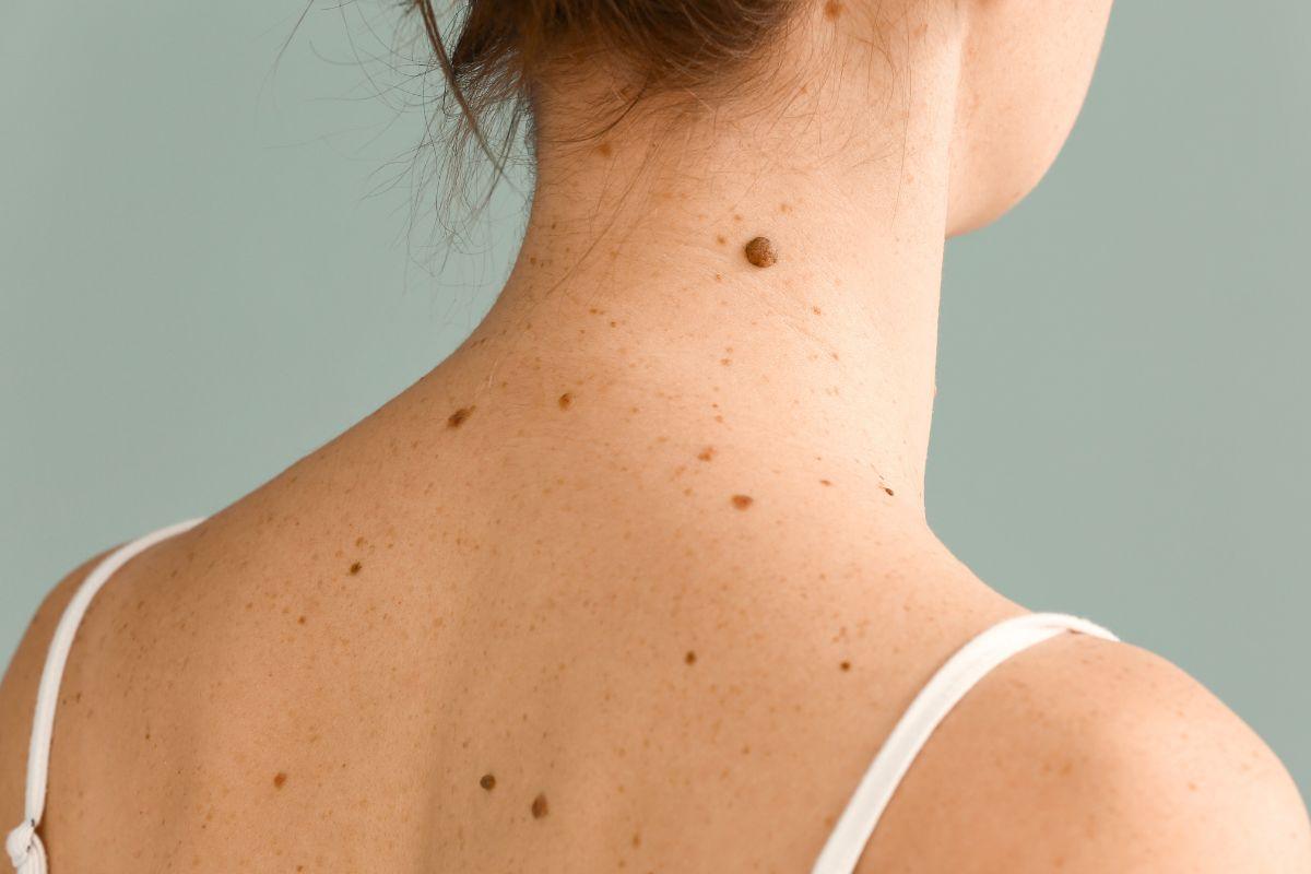 Ką apie jus išduoda apgamai: finansinės sėkmės ženklai ant kūno