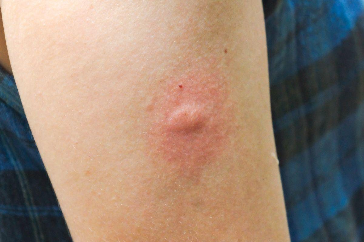 Vabzdžių įkandimai vasarą: kaip atpažinti ir tinkamai reaguoti